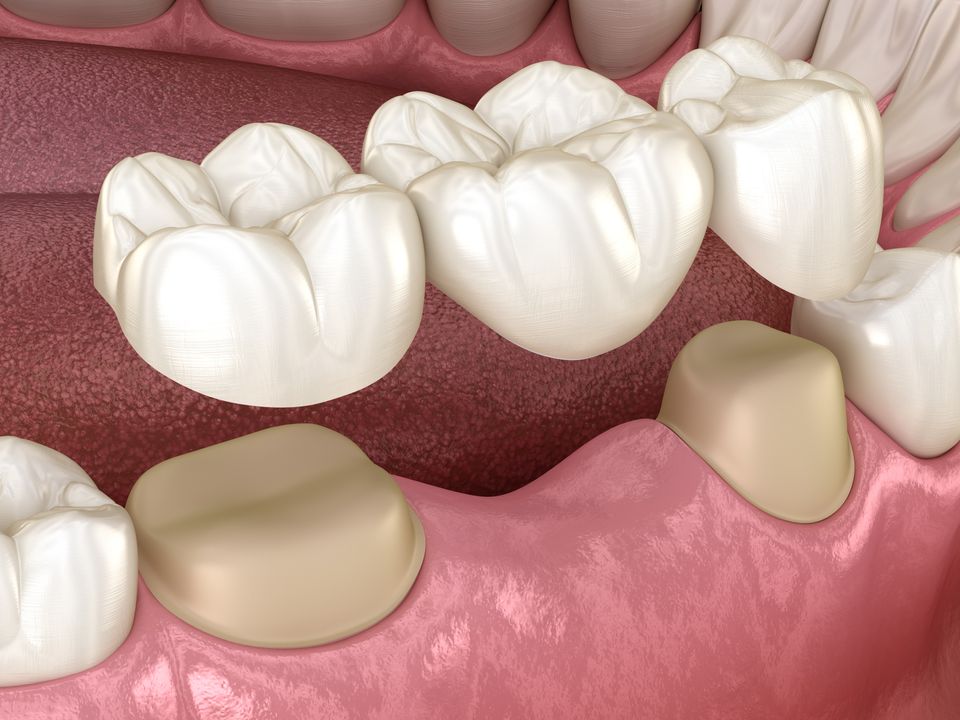 Dental Crowns & Bridges