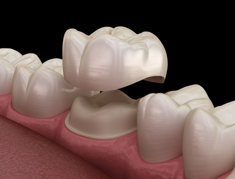 What is a Dental Crown?