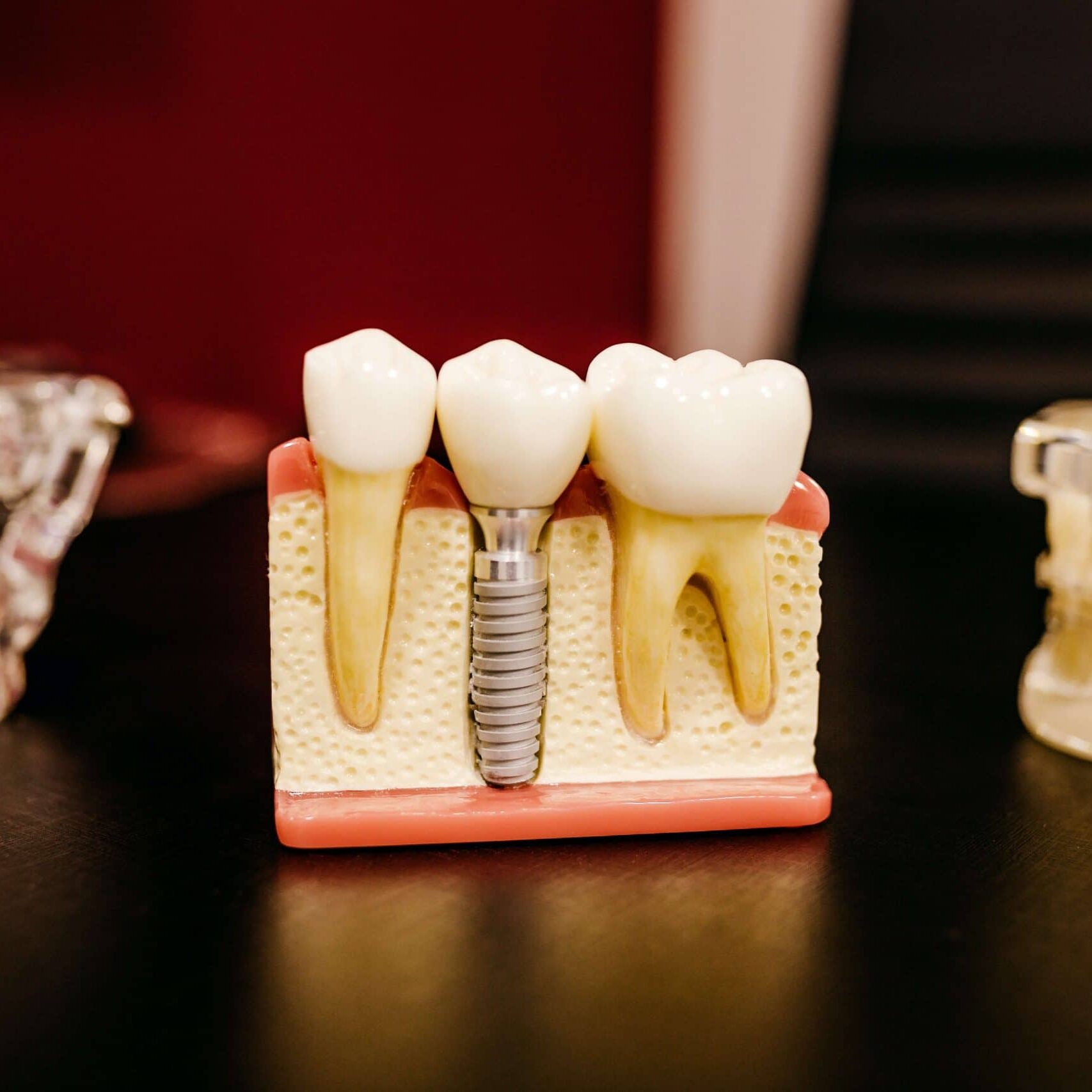 Dental Implants